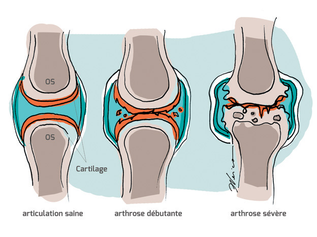 Arthrose : maladie chronique et affection dégénérative qui touche le  cartilage