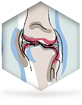 schéma genoux arthrosiques