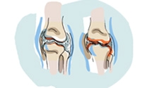 Tous ensemble pour battre les maladies arthrosiques